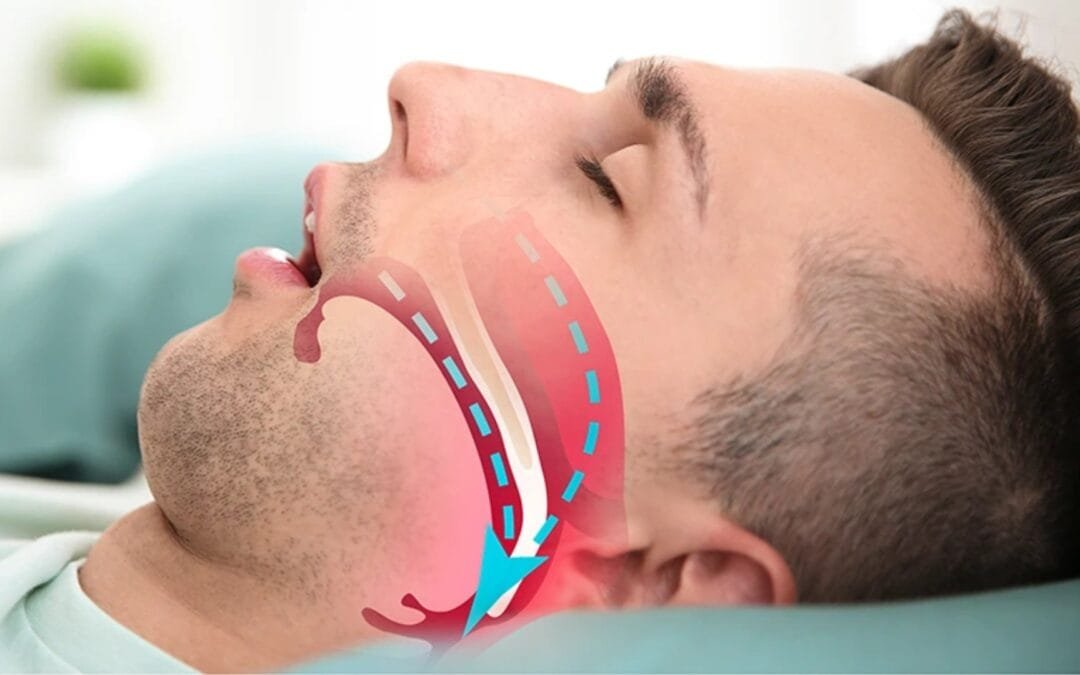 Apnea del Sueño: Un Trastorno que Afecta tu Descanso y tu Salud